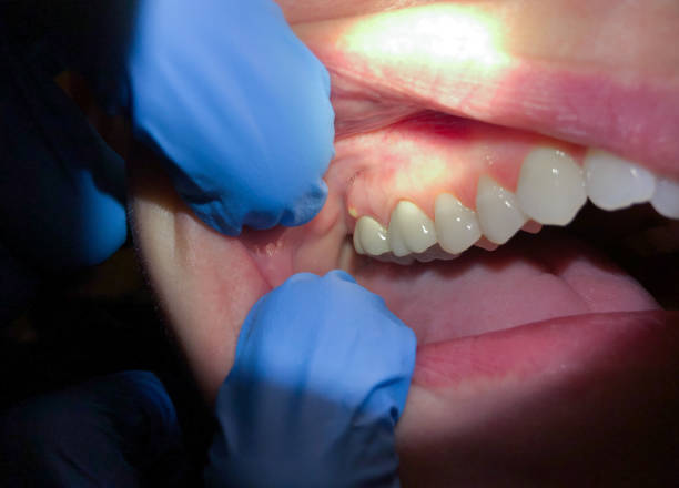 Best Broken Tooth Emergency  in Spring City, TN